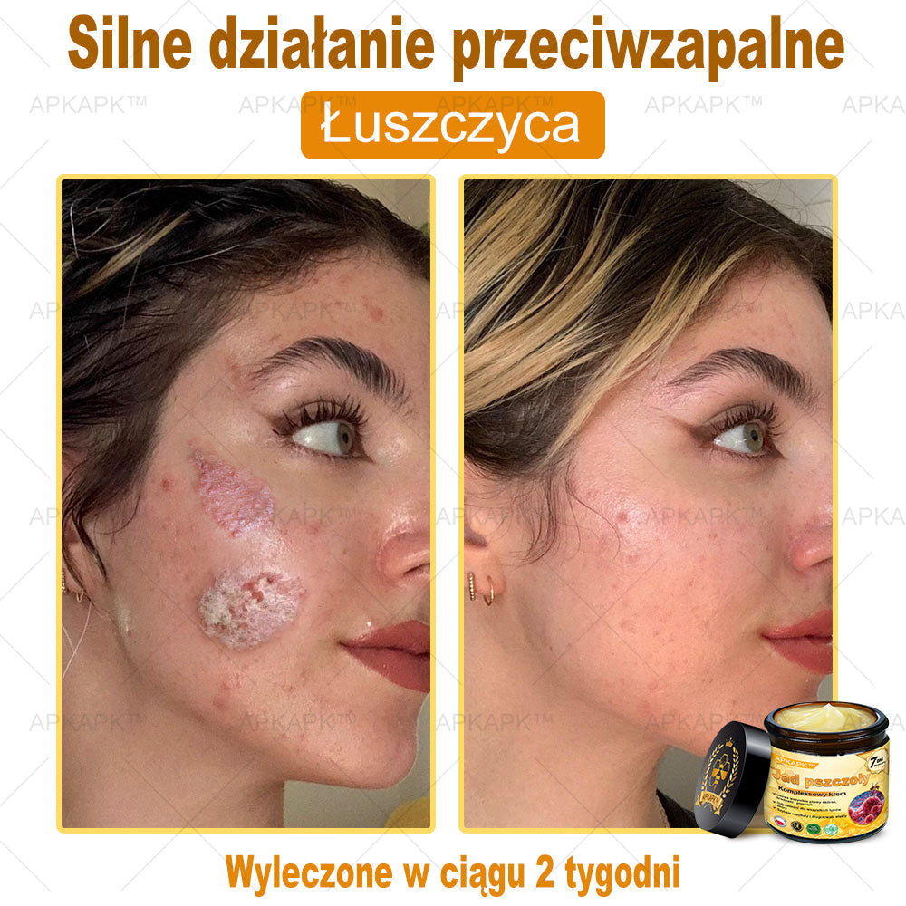 ΑPΚΑPK™Jad Pszczoły Kompleksowy Krem🧑⚕️🧑⚕️ 🥇pomaga w leczeniu problemów skórnych, takich jak: zmarszczki, blizny, plamy pigmentacyjne, rozstępy, trądzik, łuszczyca, egzema, zmiany skórne, podrażnienia, stany zapalne i inne problemy skórne🔥