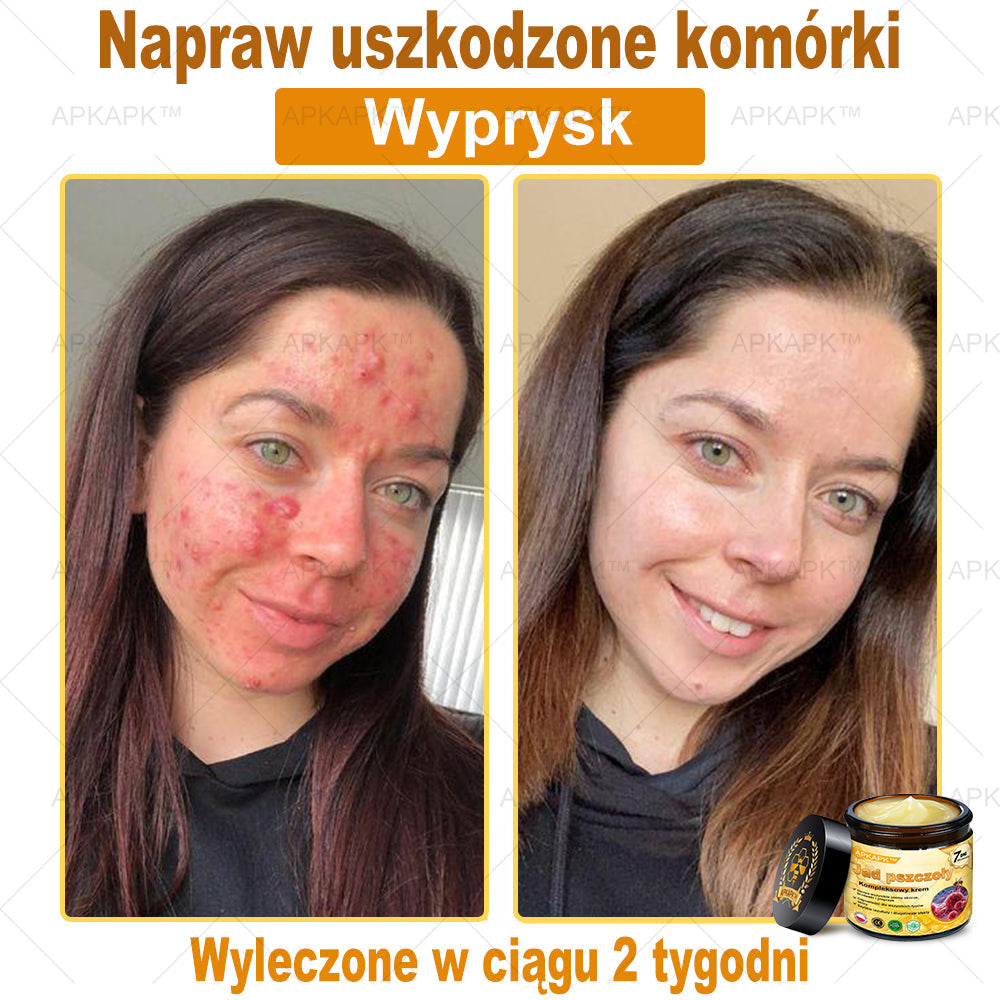 ΑPΚΑPK™Jad Pszczoły Kompleksowy Krem🧑⚕️🧑⚕️ 🥇pomaga w leczeniu problemów skórnych, takich jak: zmarszczki, blizny, plamy pigmentacyjne, rozstępy, trądzik, łuszczyca, egzema, zmiany skórne, podrażnienia, stany zapalne i inne problemy skórne🔥