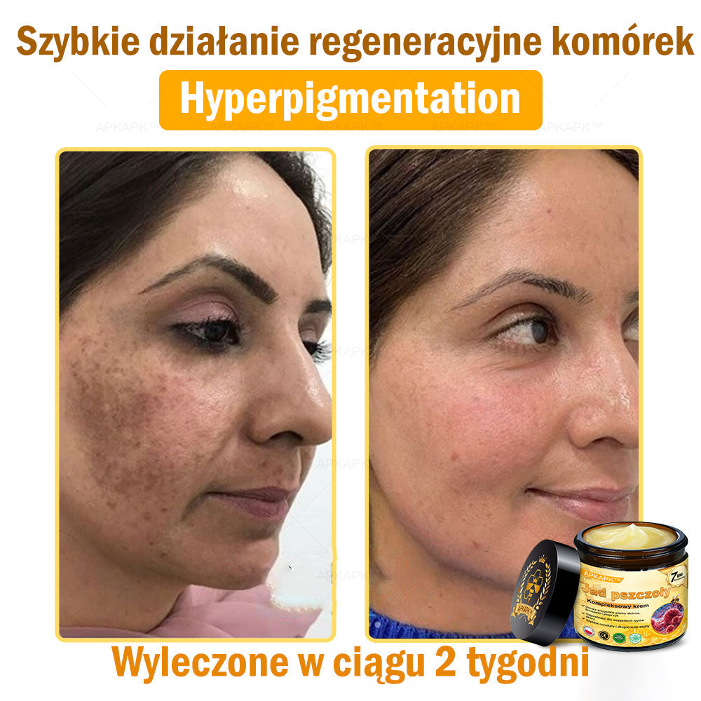 ΑPΚΑPK™Jad Pszczoły Kompleksowy Krem🧑⚕️🧑⚕️ 🥇pomaga w leczeniu problemów skórnych, takich jak: zmarszczki, blizny, plamy pigmentacyjne, rozstępy, trądzik, łuszczyca, egzema, zmiany skórne, podrażnienia, stany zapalne i inne problemy skórne🔥